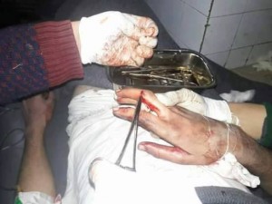 معالجه دون تخدير